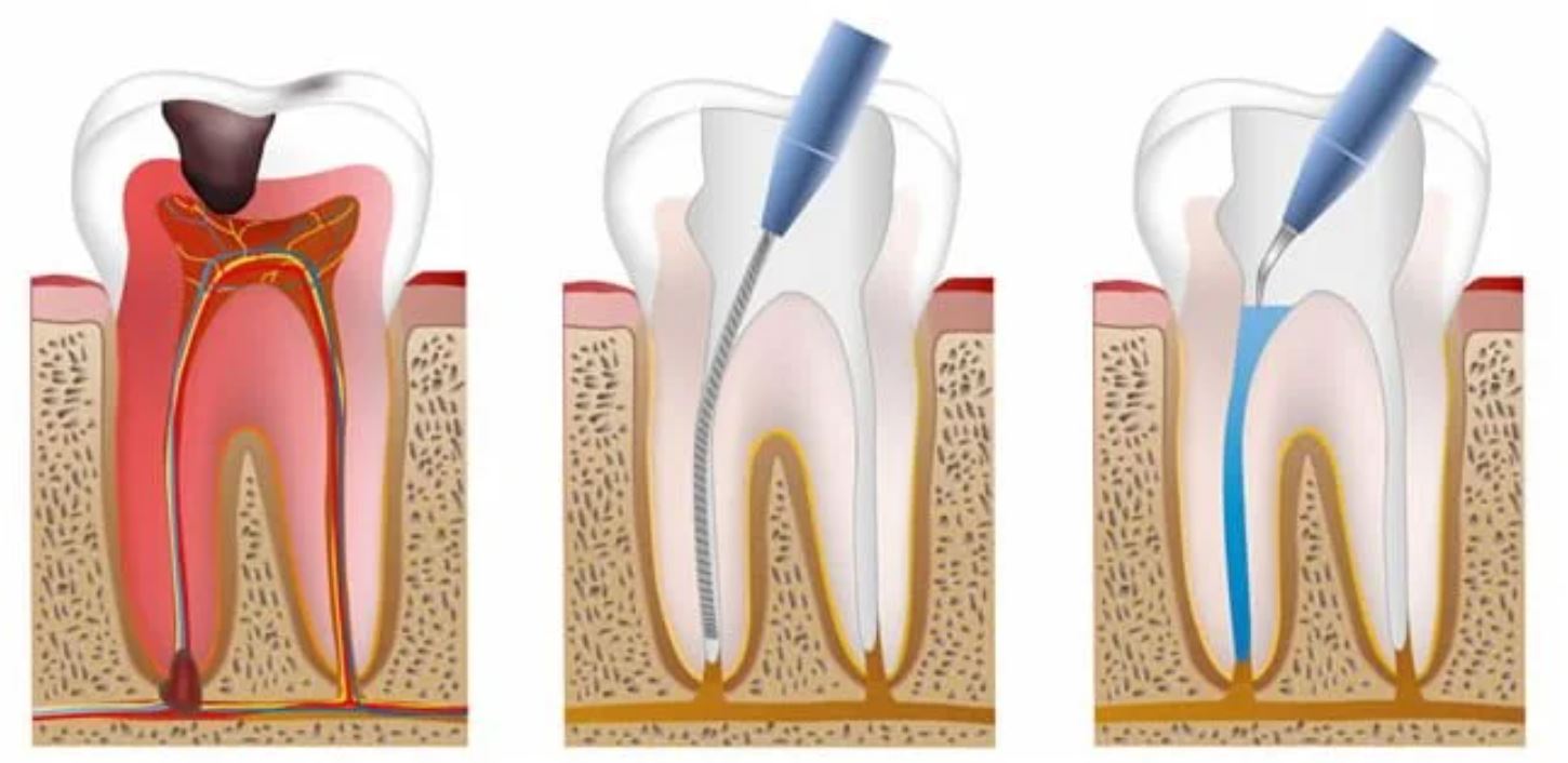 Three-stage illustration showing infected dental pulp, cleaning of the root canals, and filling and sealing the tooth