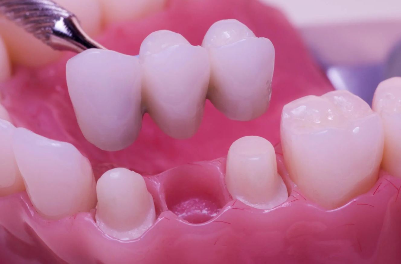 Dental bridge positioned above prepared supporting teeth to replace a missing tooth