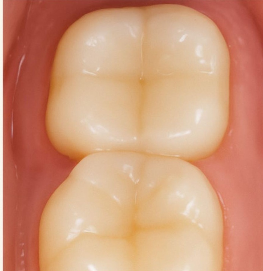 The same molar restored with a seamless tooth-colored composite filling.
